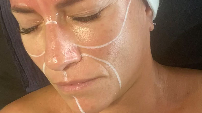 Dermapen (Inducción de Colágeno)